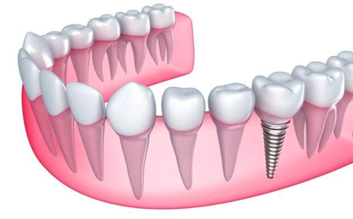 implantologia dental mallorca